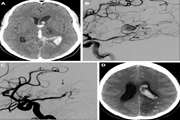 Traumatic Dissecting Posterior Cerebral Artery Aneurysm: A Case Report and Review of the Literature